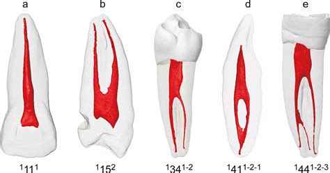 Root Canal Anatomy Of Mandibular Incisors And Mandibular Canines Varies | My XXX Hot Girl