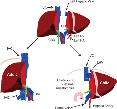 The liver transplant operation | Health and wellbeing | Queensland ...