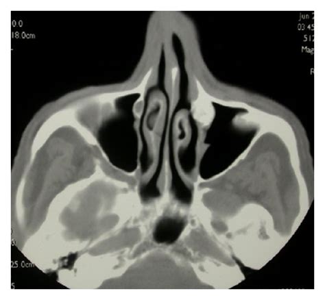 Axial view of the CT scan of the paranasal sinus showing the osteoma of... | Download Scientific ...