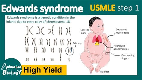 Understanding Edwards' Syndrome: Causes, Symptoms, and Treatment - Ask The Nurse Expert