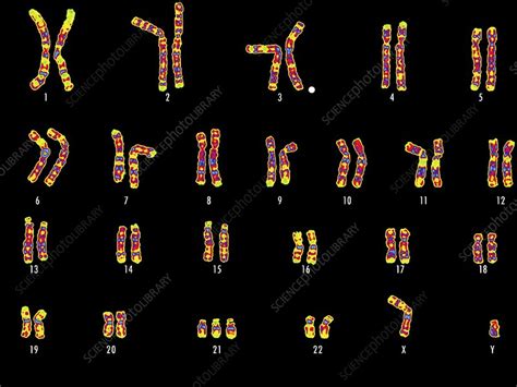 Down Syndrome Karyotype : Trisomy 21 - Embryology - Down syndrome may be suspected if a newborn ...