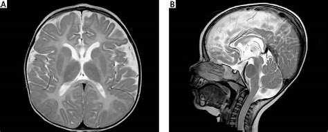 Pelizaeus Merzbacher disease, causes, symptoms, diagnosis, treatment & prognosis