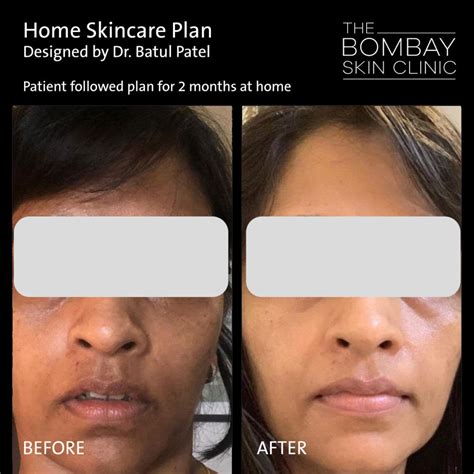 Before After Treatment Skin & Hair Treatment Photos | Dr. Batul Patel