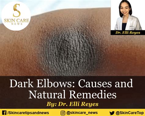 Dark Elbows: Causes and Natural Remedies : Skin Care Top News