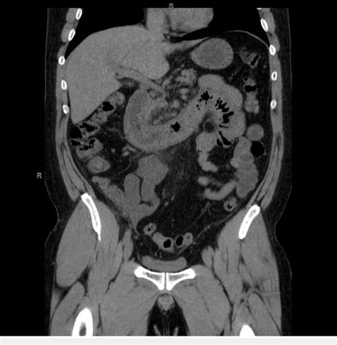 Ct Scan Abdomen Pelvis Anatomy