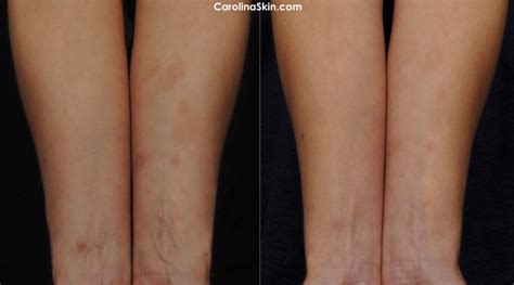 Scar Treatment Charlotte | Dermatology, Laser & Vein Specialists