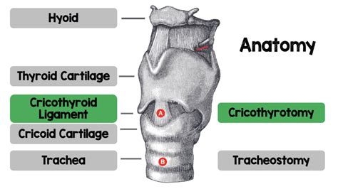 Cricothyroidotomy Vs Tracheostomy