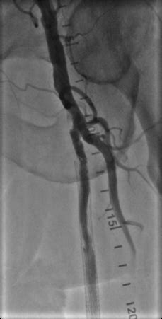 Common Femoral Artery Stenosis