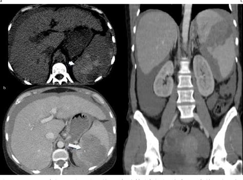 Figure 6 from Spontaneous abdominal hemorrhage : imaging evaluation ...