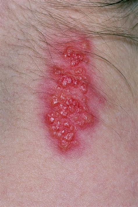 Close-up Of Shingles Rash On Back Of Woman's Neck Photograph by Dr P. Marazzi/science Photo Library