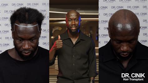 Arsenal Legend Bacary Sagna Reborn with Dr. Cinik's Hair Transplant