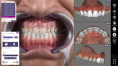 Digital Smile Design - Prodenta Dental Laboratories