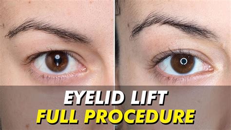 Non Surgical Treatment For Hooded Eyelids - Captions Trend