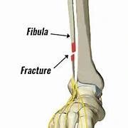 Fibula Fracture - Types, Causes, and Treatment Options