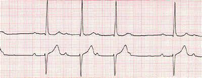 ECG.