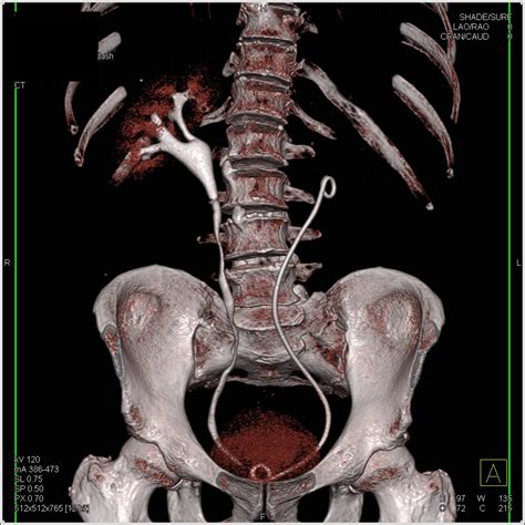 Stent in Left Renal Pelvis in 3D - Kidney Case Studies - CTisus CT Scanning