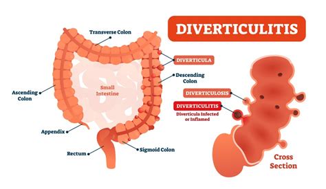 10 Signs Of Diverticulitis - AdsClerk