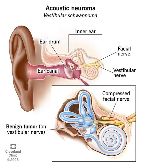 Acoustic Neuroma (Vestibular Schwannoma): Symptoms