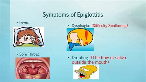 Acute epiglottitis by Joselyn