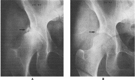 A, Radiograph of the patient's right hip taken in April 1985. Note the... | Download Scientific ...