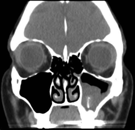 Maxillary Sinus Infection