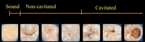 Caries Assessment / Diagnosis Flashcards | Quizlet