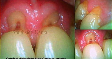 SOUTH SIDE DENTAL: Cervical abrasions or non carious lesions