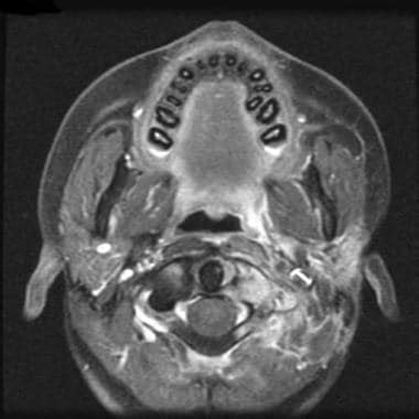 Parotid Gland Tumor Mri