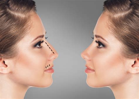 Nose Thread Lift In Singapore: Your Official Guide On This Non-Surgical Treatment