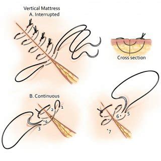 Needle point types: taper point, reverse cutting, conventional cutting,... | Download Scientific ...