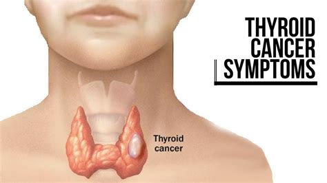 Thyroid Nodules On Neck Pictures to Pin on Pinterest - ThePinsta