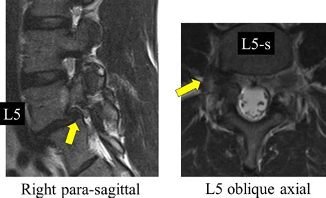 Successful Endoscopic Surgery for L5 Radiculopathy Caused by Far-Lateral Disc Herniation at L5 ...