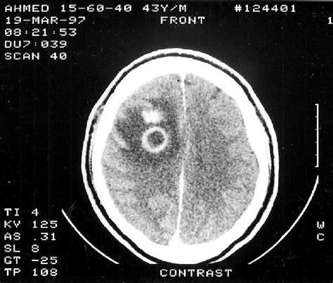 Case 2: CT scan of brain revealing a ring-enhancing lesion in the right... | Download Scientific ...