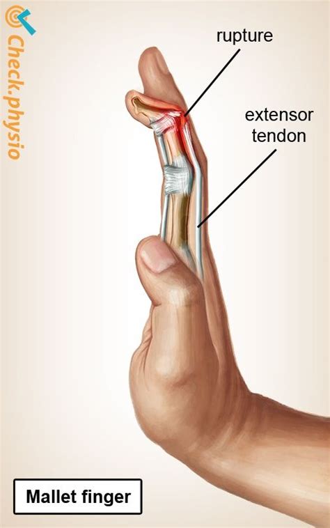 2018-08-21 - In the case of mallet finger, the tendon that extends the ...