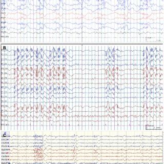 Clinical characteristics of patients JME and myoclonicus status epilepticus | Download ...