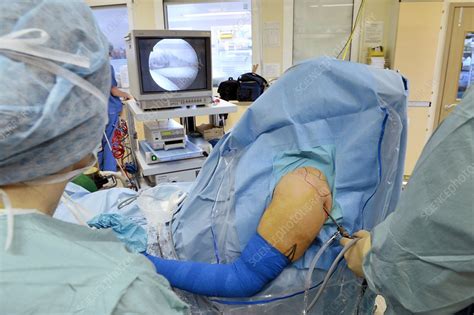 Shoulder arthroscopy procedure - Stock Image - M440/0245 - Science ...