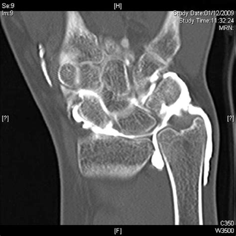 CT arthrogram showing contrast leak through TFCC tear | Download ...