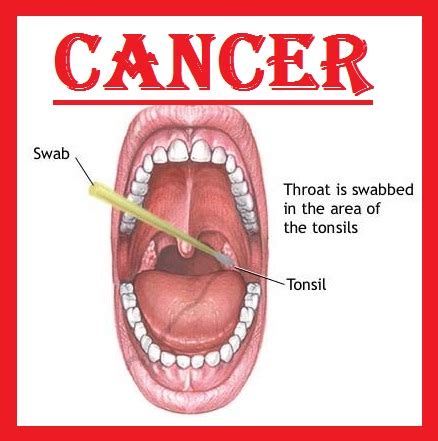 throat cancer info: what is throat cancer