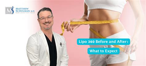 Lipo 360 Before and After: What to Expect | Matthew Schulman, M.D.