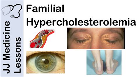 Familial Hypercholesterolemia | Genetics, Pathophysiology, Symptoms and Treatment - YouTube