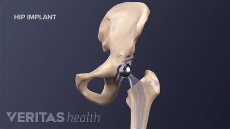 Advantages And Disadvantages Of Anterior Hip Replacement, 58% OFF