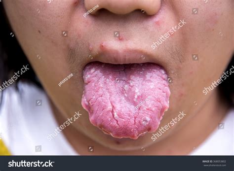 Bacterial Infection Disease Tongue,The Tongue Is Thrush,Fissured Tongue ...