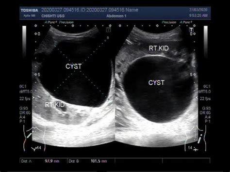 Ultrasound Video showing a large Renal Cyst. - YouTube