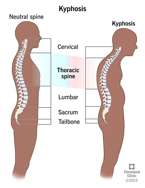 Treatment of kyphosis - MEDizzy