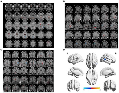 Frontiers | Functional brain activity in patients with amnestic mild cognitive impairment: an rs ...