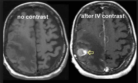 MRIs and contrast gadolinium | Powerful Patient