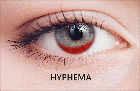 Causes of Hyphema Archives | Dr. Vikram Chauhan's Blog