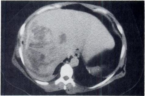 A&B Hepatic adenoma (A) This unenhanced CT scan of an hepatic adenoma... | Download Scientific ...