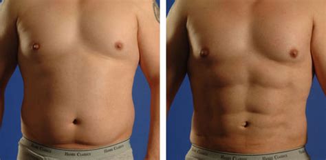 Liposuction Treatment Harley Street | Vaser Lipo London