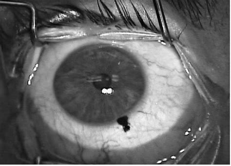 The Right Eye: Inadvertent Pigmentation of the Limbus following... | Download Scientific Diagram